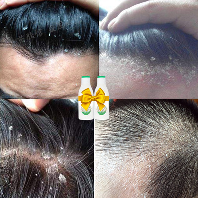 告别头屑与瘙痒 如何选择适合脂溢性头皮的无硅油去螨洗发水
